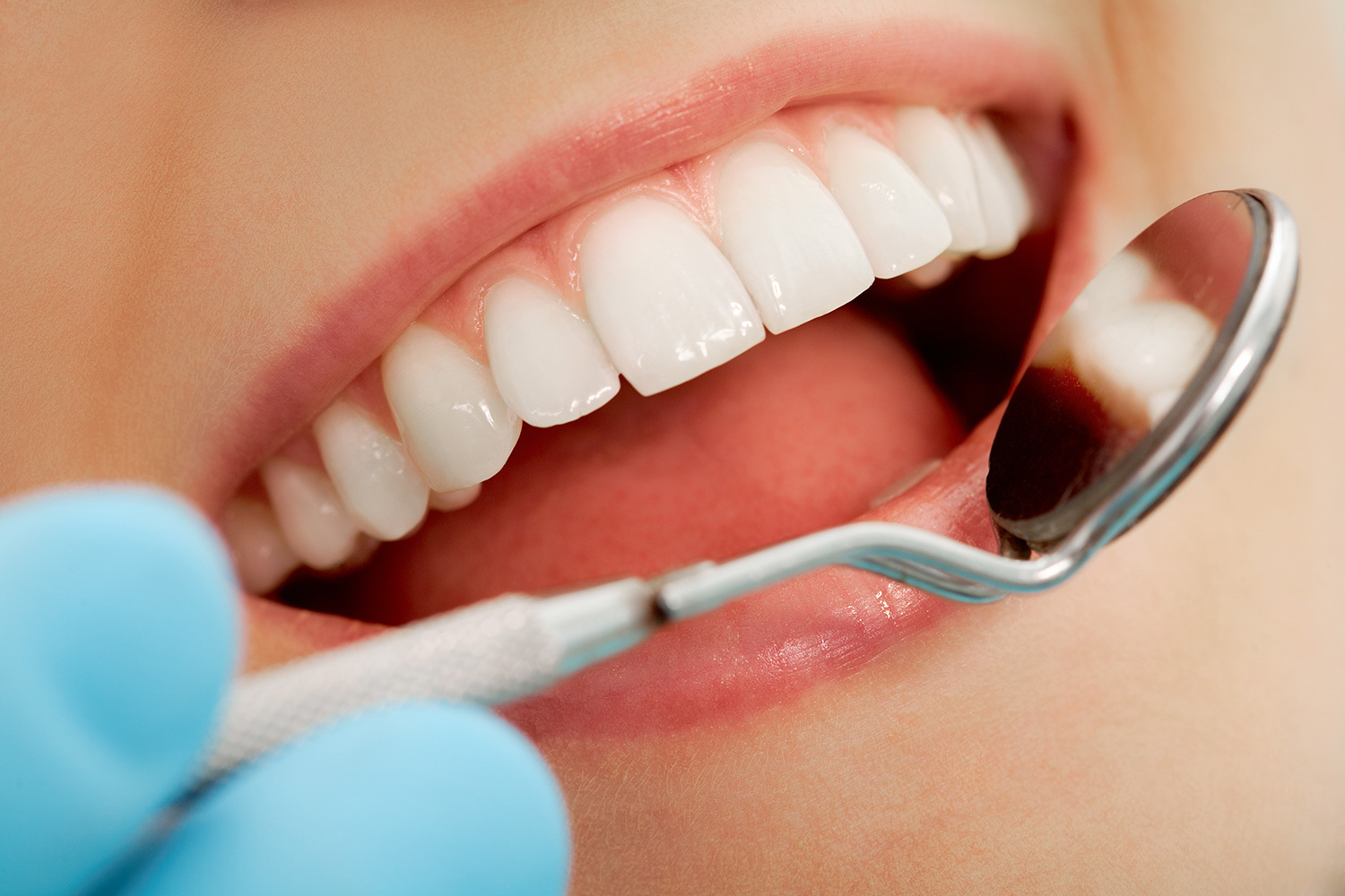 Teeth Whitening 